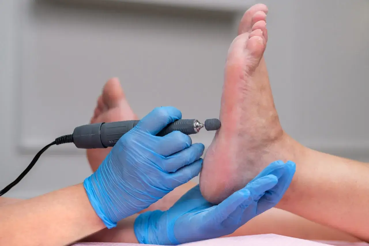 Profesjonalny pedicure z użyciem frezarki, by zapobiec pękającym piętom. Babcia zawsze mówiła, że to najlepsze porady na pękające pięty.