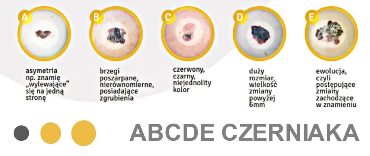 ABCDE - cechy czerniaka: asymetria, brzegi, kolor, duży rozmiar, ewolucja.