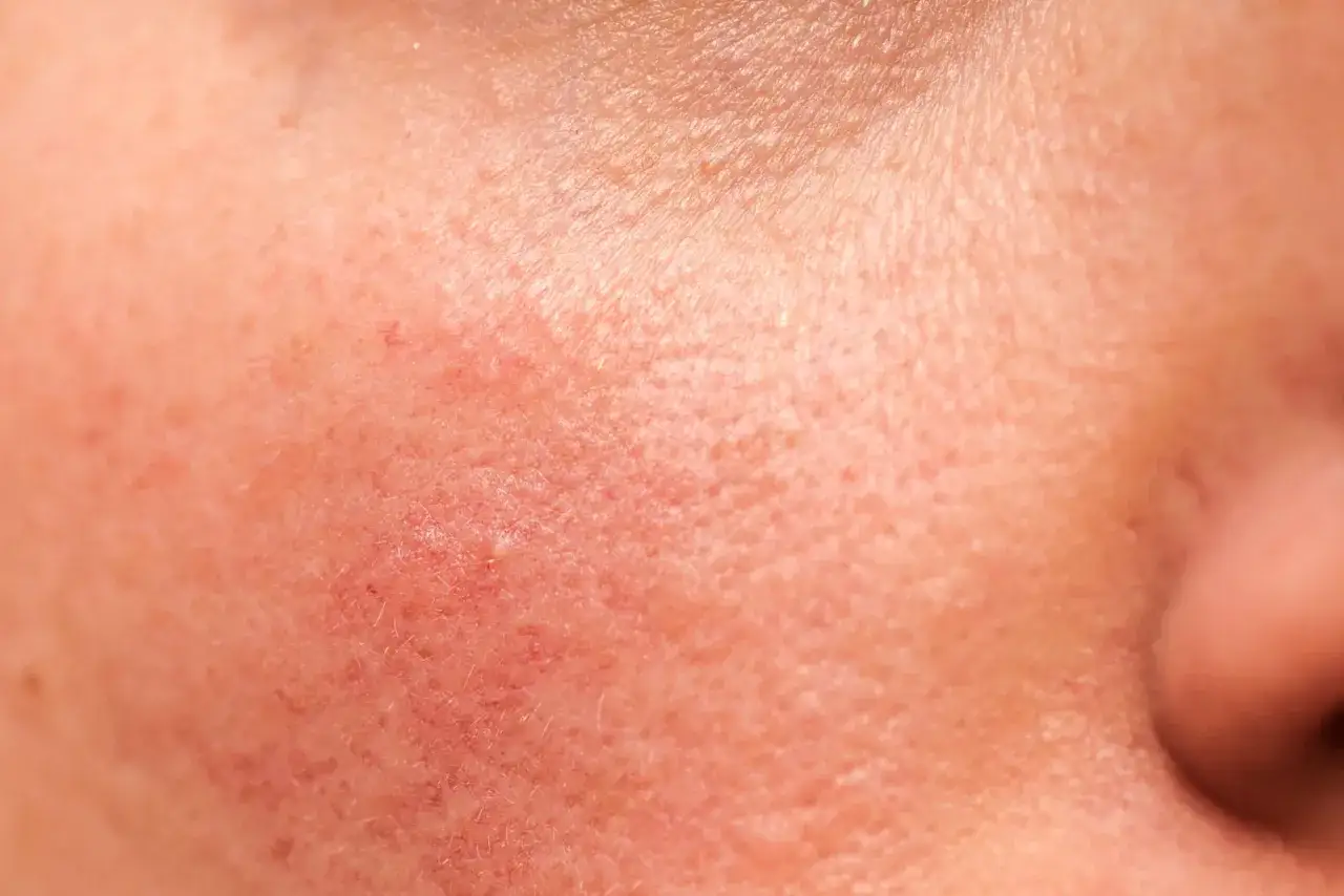 Skóra z widocznymi naczynkami i zaczerwienieniem, objawy dermatozy.