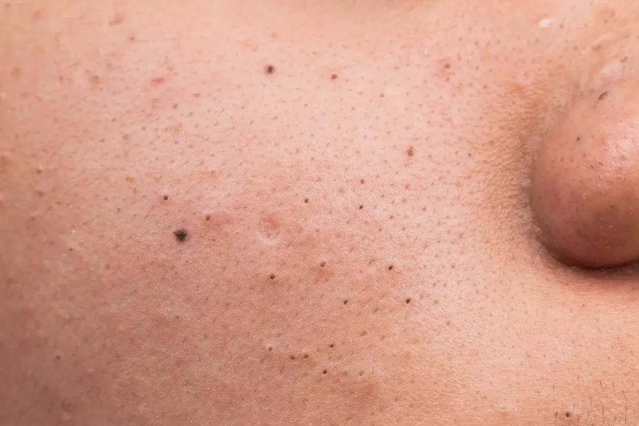 Peeling kawitacyjny przed i po zabiegu