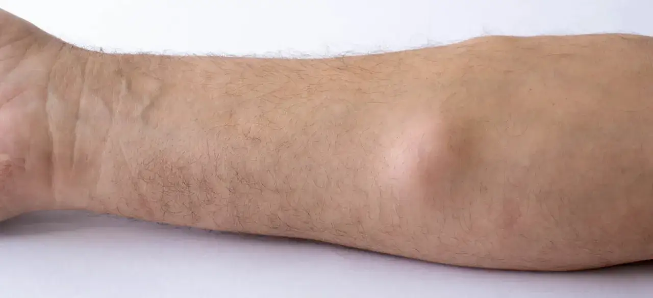 Widoczny na przedramieniu łagodny tłuszczak (lipoma) tworzy niewielkie, miękkie wybrzuszenie pod skórą.