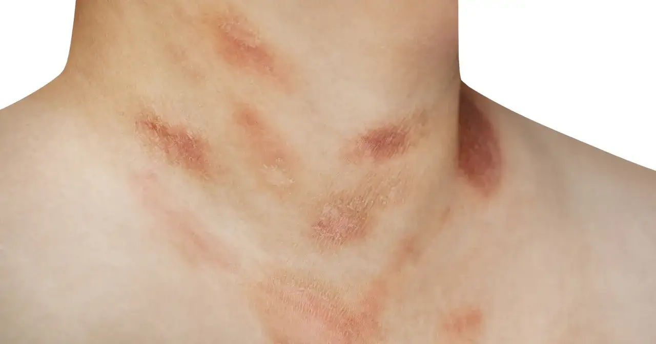 Skóra na szyi i klatce piersiowej z łupieżem różowym Giberta. Widoczne owalne, łuszczące się plamy o różowym zabarwieniu.
