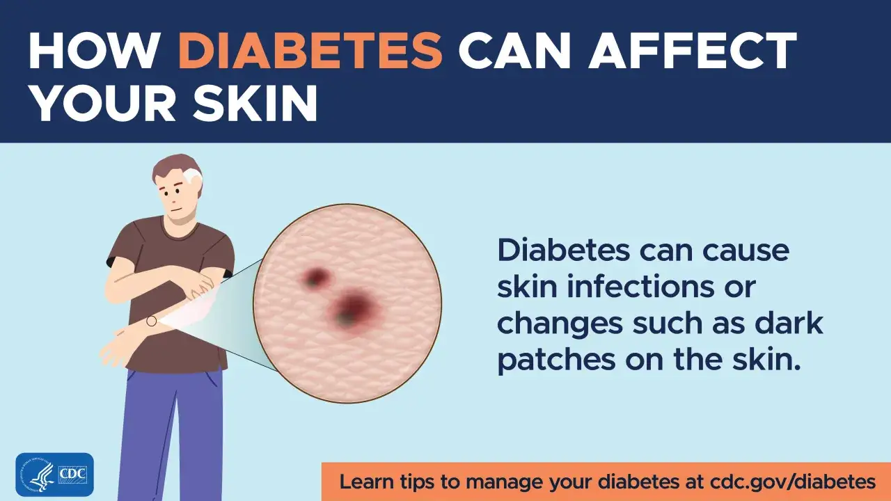 Ciemne plamy na skórze, objawy cukrzycy, mogą pojawić się z powodu infekcji. Dowiedz się więcej na cdc.gov/diabetes.