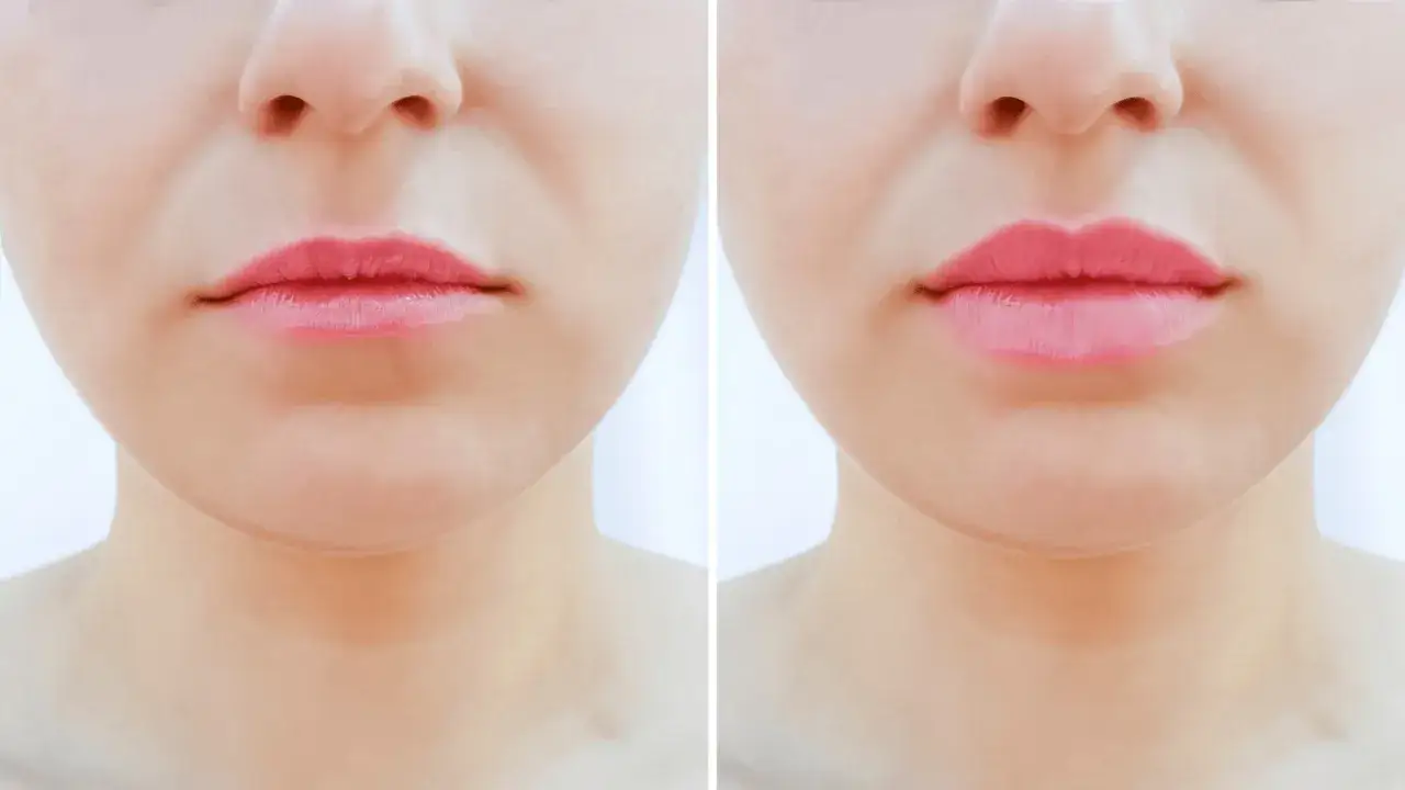 Przed i po zabiegu botox lip flip. Usta stały się pełniejsze i bardziej zdefiniowane.