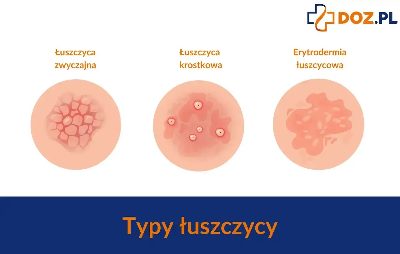 Ilustracje przedstawiają trzy typy łuszczycy skóry: łuszczycę zwyczajną z łuskami, łuszczycę krostkową z pęcherzykami i erytrodermię łuszczycową.